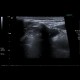 Cervical cyst, medial, retention cyst: US - Ultrasound